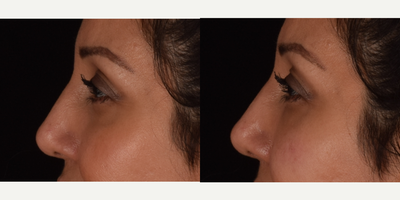 Tear Trough Augmentation with Platelet Rich Fibrin (PRF) - Results demonstrate before and immediate afters for under eye circle treatment. Now instead of solely injecting dermal fillers for volume loss, Dr. Kian has started the newest, most innovative approach, as he likes to describe cutting edge treatment for injectable fillers. This treatment formula now includes the addition of platelet rich fibrin (PRF) into the mix. PRF is the newest generation of PRP (platelet rich plasma) and contains platelets, fibrin, and a small concentrations of stem cells. The added benefits of PRF include greater volume enhancement, as the solution turns into a gel-like substance, and promotion of collagen production and stimulation, in turn improving overall skin quality with time. In addition to these benefits for correcting volume depleted areas and promoting skin rejuvenation, the treatment is done by the use of a micro-cannula (blunt tip instrument) essentially eliminating any chances for bruising.