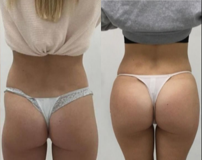 woman treated with Non Surgical Butt Augmentation - Non surgical butt augmentation