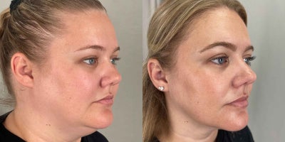 25-34 year old woman treated with Tirzepatide for Weight Loss - This 34-year-old patient achieved remarkable results with the Skinny Shot. In the before photos, taken in December 2023, she displays noticeable fullness in the face and under the chin. The after photos, taken in July 2024, reveal a slimmer, more defined facial contour with enhanced definition in the jawline and cheeks. The Skinny Shot is designed to support healthy weight loss and body contouring, helping patients feel more confident and refreshed. The transformation is both natural and stunning!