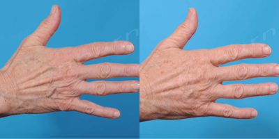 65-74 year old woman treated with Hand Rejuvenation - hand rejuvenation with 1.5cc Radiesse each hand