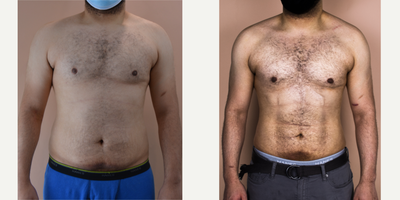 25-34 year old man treated with Abdominal Etching - This young male requested hi-definition liposuction of his abdomen to remove unwanted, exercise-resistant fat. He is shown her at 2 months post-op. The beauty of this operation is that the results will continue to improve because the definition is created to complement the underlying anatomy.