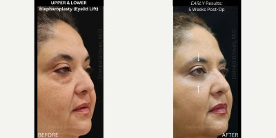 UPPER & LOWER Blepharoplasty (Eyelid Lift Surgery) | Undereye Bags | Bulging | Fat Herniation | Loose Excess Skin | Look Tired | - My patient had SEVERE lower eyelid bags that were getting worse over time. She also had excess upper eyelid skin. She was constantly being told she looks tired and she wanted to rejuvenate her face to get a more youthful appearance before her wedding in a few weeks! She was MOST bothered by her eyelids. - - - To correct her problems, I performed an upper and lower blepharoplasty (eyelid lift). - - - She required:  Precise removal of her excess UPPER eyelid skin, carefully hiding the scar in her natural eyelid crease (so it would heal invisibly)  Careful removal of the herniated LOWER eyelid bulging fat (which cause the lower lid bags)  Suspension of the ORBICULARIS muscle to the bony orbital rim- to restore the muscle anatomy to a more natural position and decrease the likelihood of recurrent bulging after surgery  Delicate suture placement to close the incisions in such a way that they heal properly and the final scars are basically invisible - - - Her case highlights why you should ONLY trust your face with an experienced Facial Plastic Surgeon! 