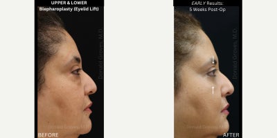 UPPER & LOWER Blepharoplasty (Eyelid Lift Surgery) | Undereye Bags | Bulging | Fat Herniation | Loose Excess Skin | Look Tired | - My patient had SEVERE lower eyelid bags that were getting worse over time. She also had excess upper eyelid skin. She was constantly being told she looks tired and she wanted to rejuvenate her face to get a more youthful appearance before her wedding in a few weeks! She was MOST bothered by her eyelids. - - - To correct her problems, I performed an upper and lower blepharoplasty (eyelid lift). - - - She required:  Precise removal of her excess UPPER eyelid skin, carefully hiding the scar in her natural eyelid crease (so it would heal invisibly)  Careful removal of the herniated LOWER eyelid bulging fat (which cause the lower lid bags)  Suspension of the ORBICULARIS muscle to the bony orbital rim- to restore the muscle anatomy to a more natural position and decrease the likelihood of recurrent bulging after surgery  Delicate suture placement to close the incisions in such a way that they heal properly and the final scars are basically invisible - - - Her case highlights why you should ONLY trust your face with an experienced Facial Plastic Surgeon! 
