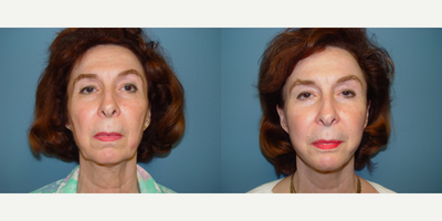 65-74 year old woman treated with Double Eyelid Surgery - This woman underwent a facelift and upper and lower blepharoplasty, seen before, and one year after her surgery.