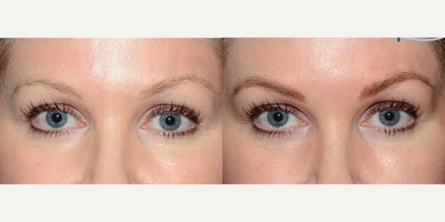 35-44 year old woman treated with Microblading - Microblading treatment of the eyebrows.