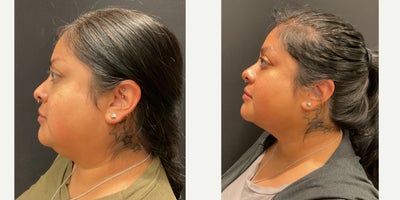 25-34 year old woman treated with Buccal Fat Removal, Renuvion, Chin Liposuction - Buccal fat pad removal with submental chin liposuction and Renuvion.