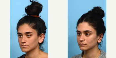 18-24 year old woman treated with Earfold, Ear Surgery - Having big ears is a common concern with a simple solution -- otoplasty, or ear surgery. Often times, overly projected ears are misconstrued as being disproportionately sized for a person's head. In truth, the issue lies in the way the ear is shaped, and by creating a new helical fold or adjusting the placement of the conchal bowl, the ears can be perceived to be much smaller. This was the case for this 24-year-old patient, who is thrilled with the outcome of her ear surgery with Dr. Wise.