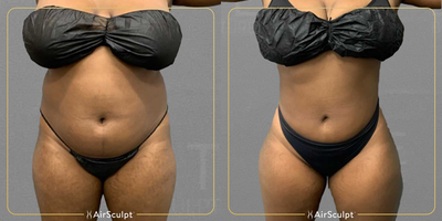 35-44 year old woman treated with AirSculpt - Many have asked about our full abdominal procedure, so check out the transformation this Atlanta patient was able to achieve only three months after her treatment.