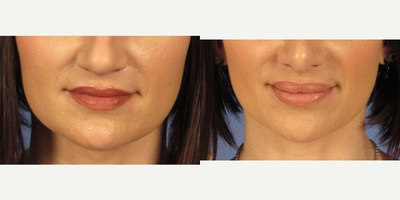 25-34 year old woman treated with Juvederm - Lip Augmentation with Juvederm.