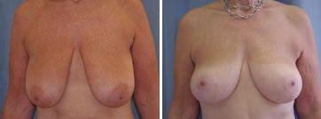 Breast Reduction before and after photo