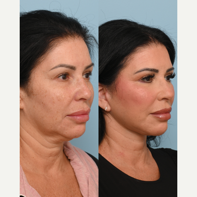 Brow Lift before and after photo