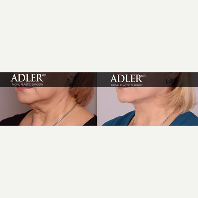 Mini Facelift before and after photo