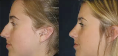 Rhinoplasty before and after photo