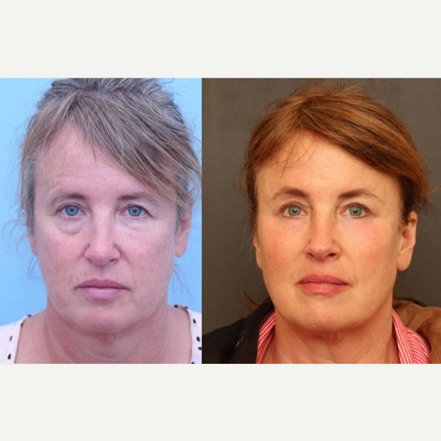 Eyelid Surgery before and after photo