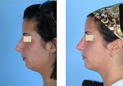 Chin Implant before and after photo