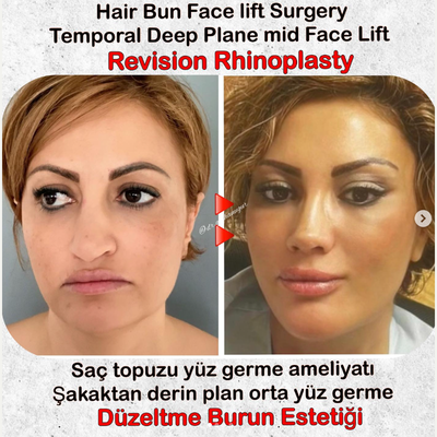 Facelift before and after photo