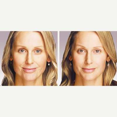 Juvederm before and after photo