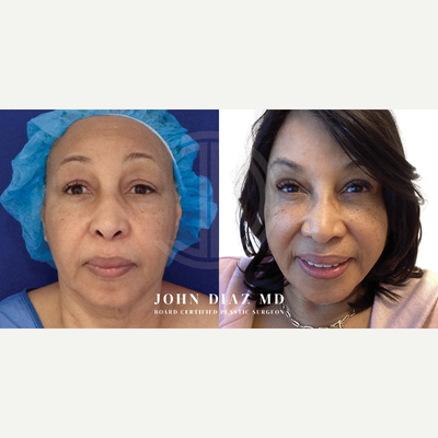 Facelift before and after photo