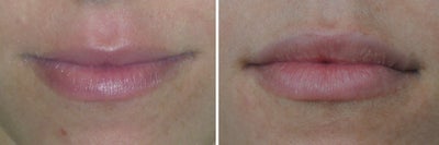 Restylane before and after photo