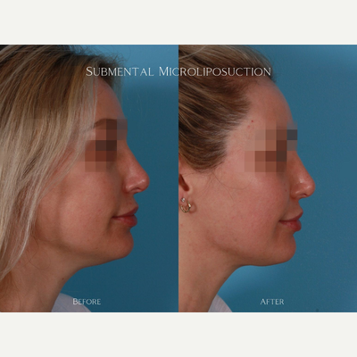 Chin Liposuction before and after photo