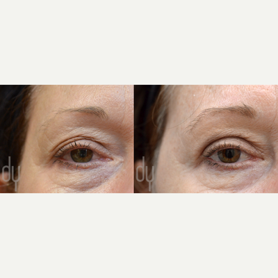 Septoplasty before and after photo