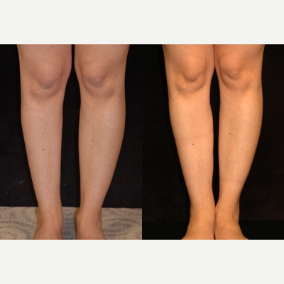 Calf Implant before and after photo