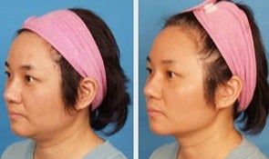 Xeomin before and after photo