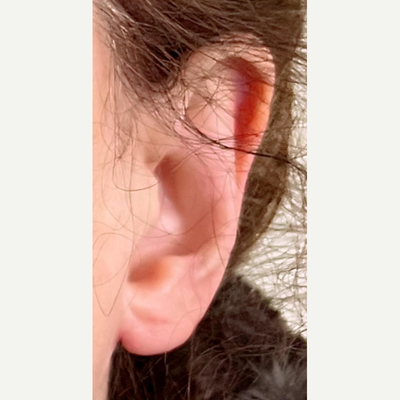 Review: I Underwent Surgery To Have My Earholes Repaired