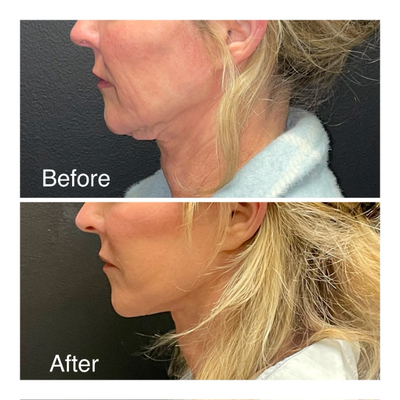 Neck Lift before and after photo