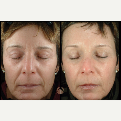 Botox before and after photo