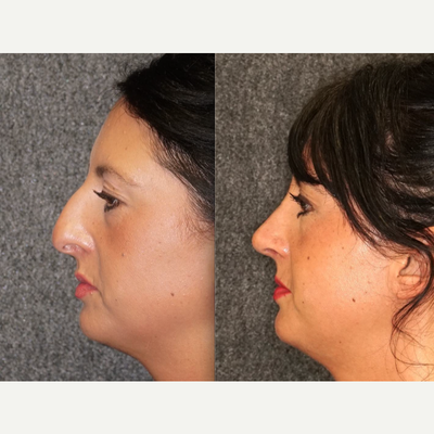 Rhinoplasty before and after photo