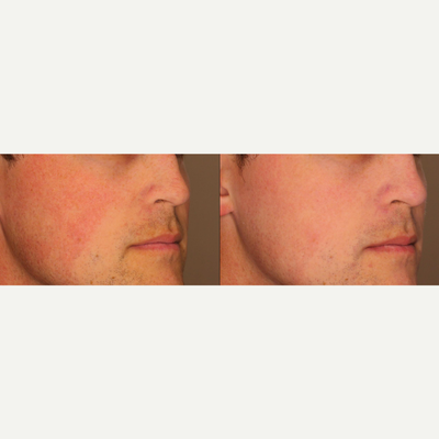 IPL before and after photo