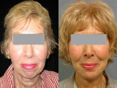 Facelift before and after photo
