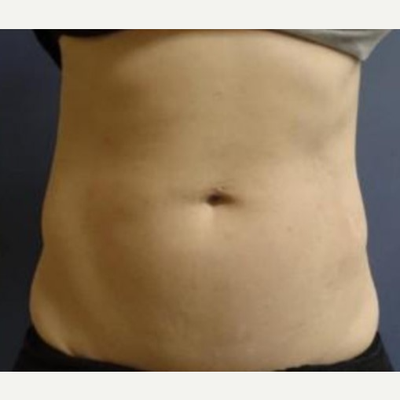 Up to 42% Off on Lipo - Non-Invasive Laser-iLipo at Perfectly Sculpted
