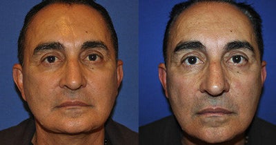 Facelift before and after photo