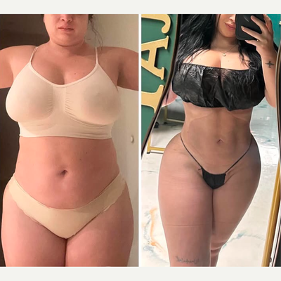 Abdominal Etching before and after photo