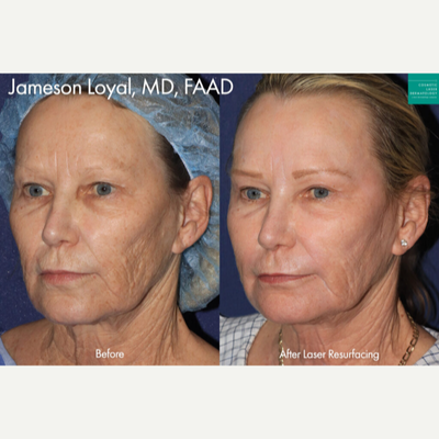 Laser Resurfacing before and after photo