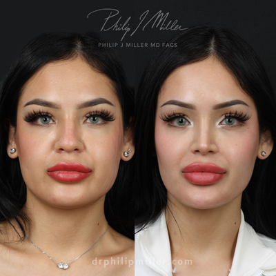 Buccal Fat Removal before and after photo