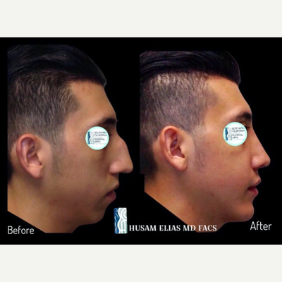 Rhinoplasty before and after photo