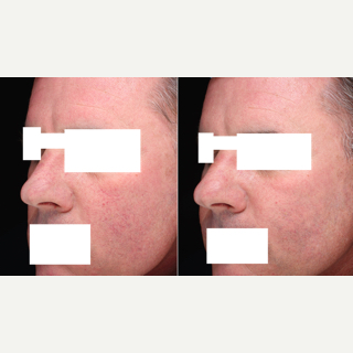 IPL before and after photo