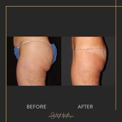 Body Lift before and after photo