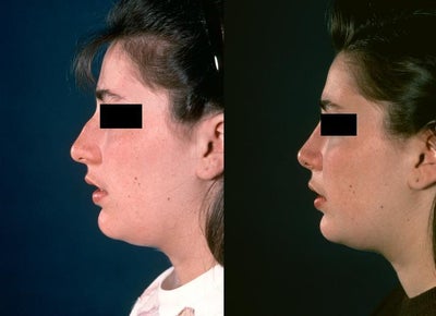 Rhinoplasty before and after photo