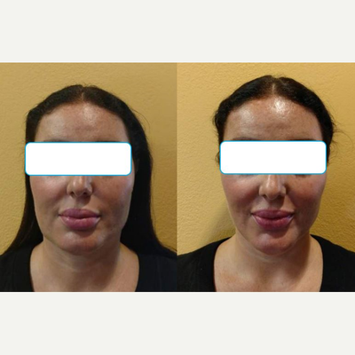 Facelift before and after photo