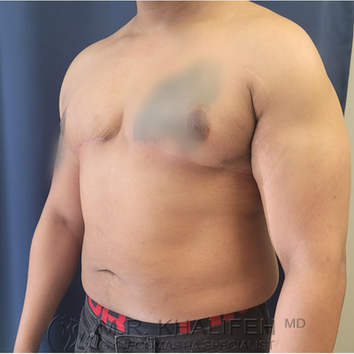 https://fi.realself.com/full/c/8/b/Gynecomastia-Surgery-after-13095685-5937597.png