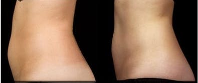 SculpSure before and after photo