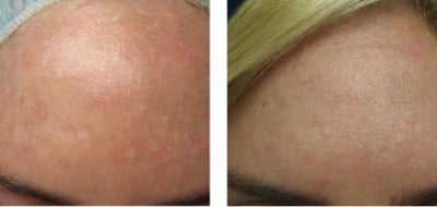 Chemical Peel before and after photo
