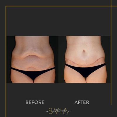 Body Lift before and after photo