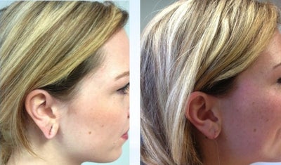 Earlobe Repair before and after photo