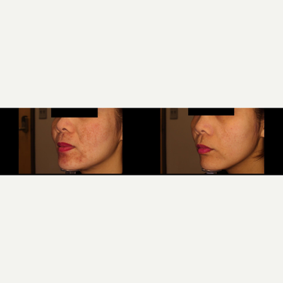 YAG Laser before and after photo
