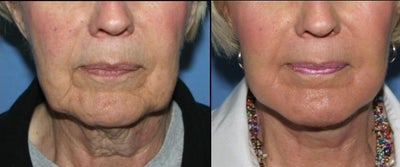 Facelift before and after photo